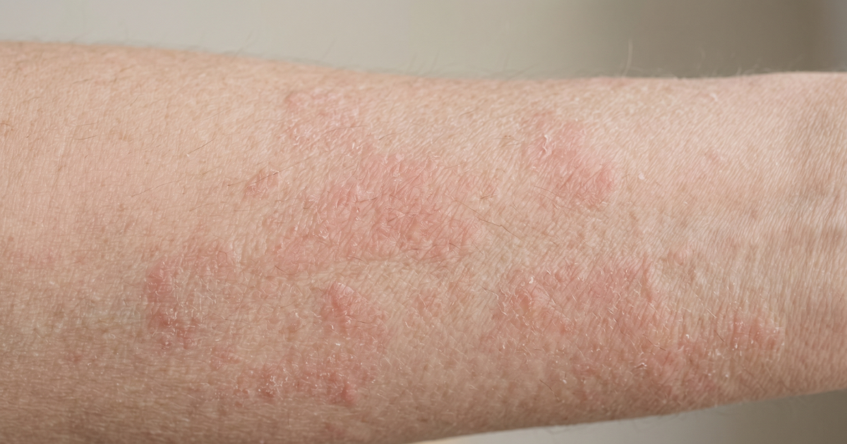 image of stasis dermatitis