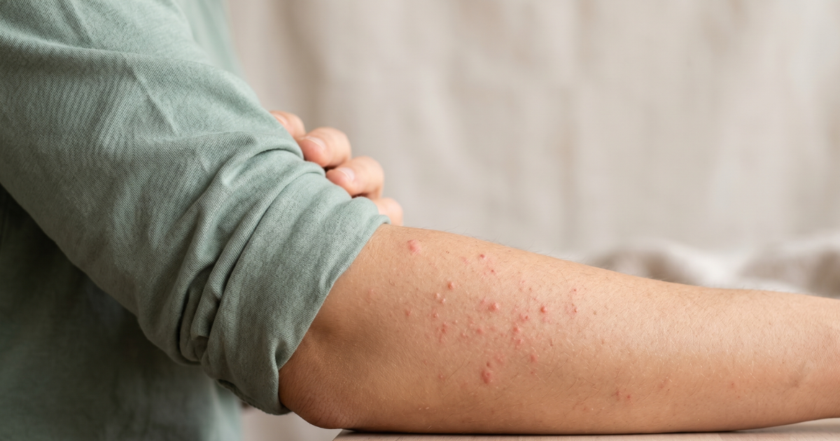 Itchy Red Bumps on Skin – Potential Causes