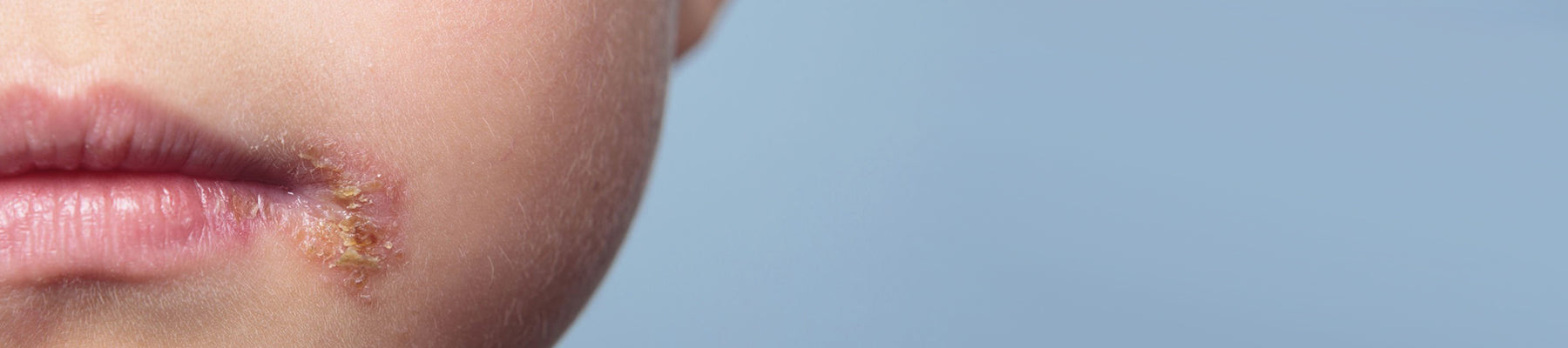 How to Heal Impetigo?