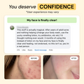 2-Step Acne Routine