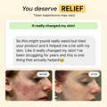 2-Step Acne Routine