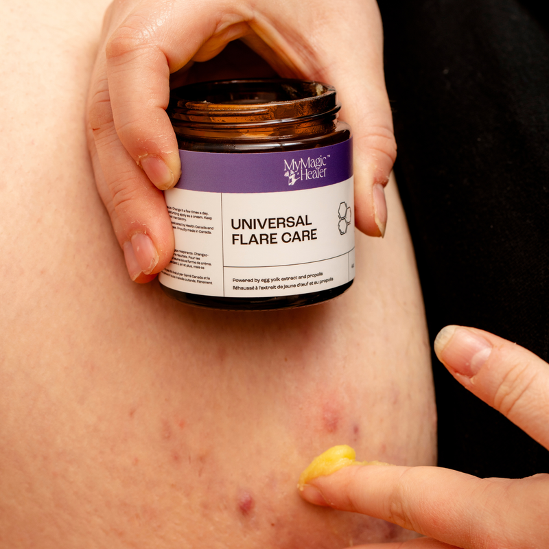 Myth: “There’s no real product made for HS-prone skin.”