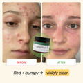 Teen Skin Flare Care Routine