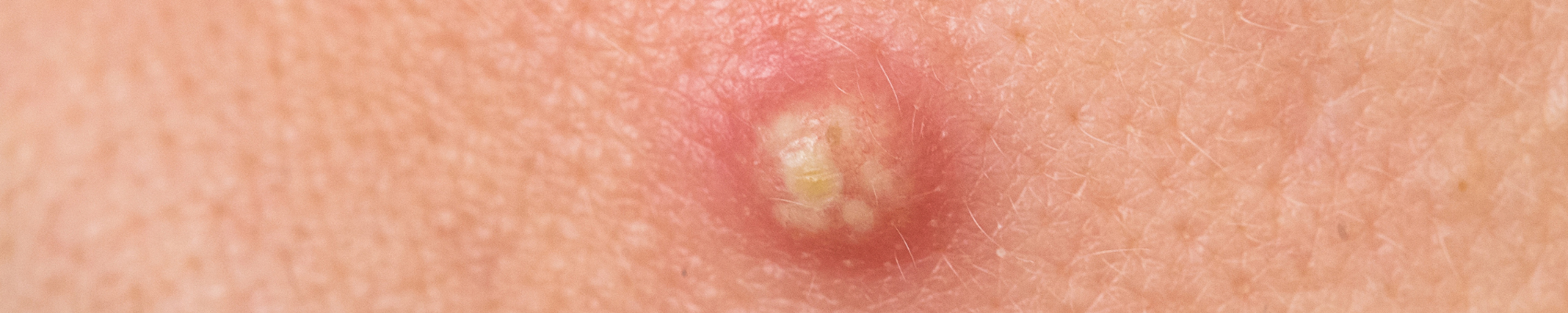 How to Drain Boils Painlessly with Universal Flare Care