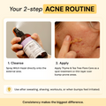 2-Step Acne Routine