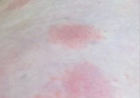 RASHES