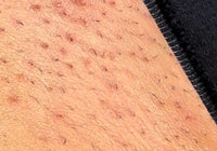 INGROWN